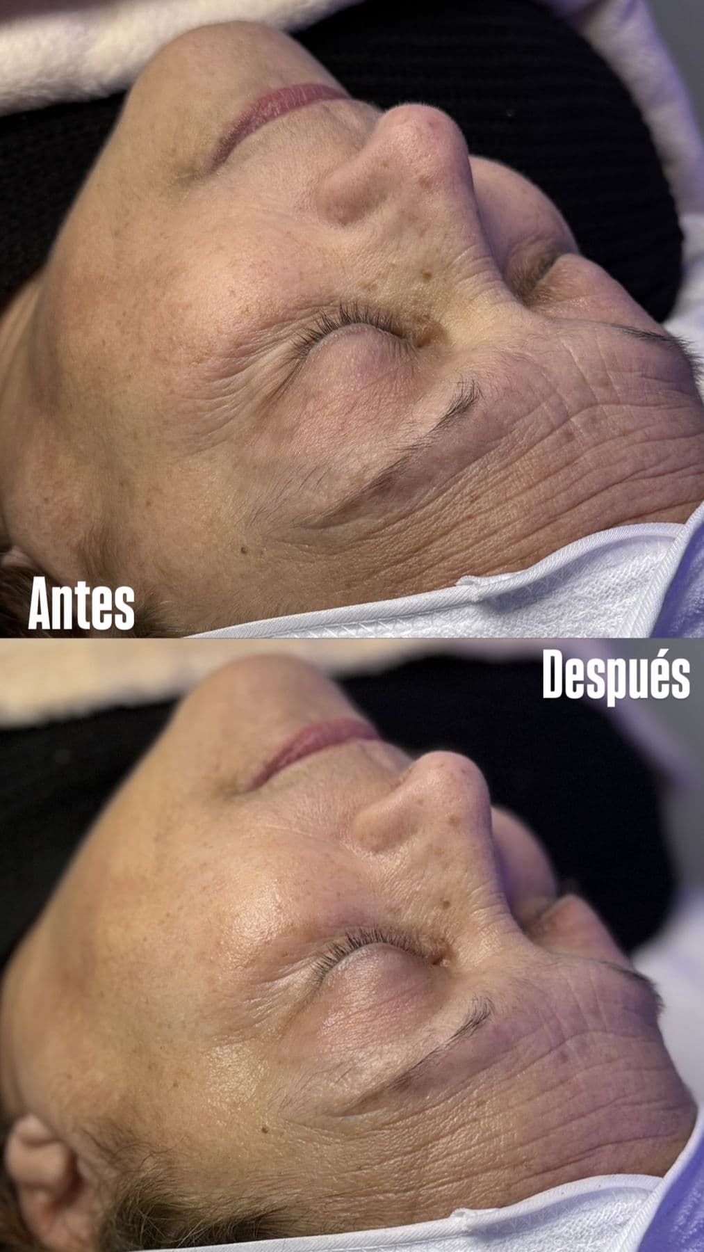 Tratamiento facial, antes y después